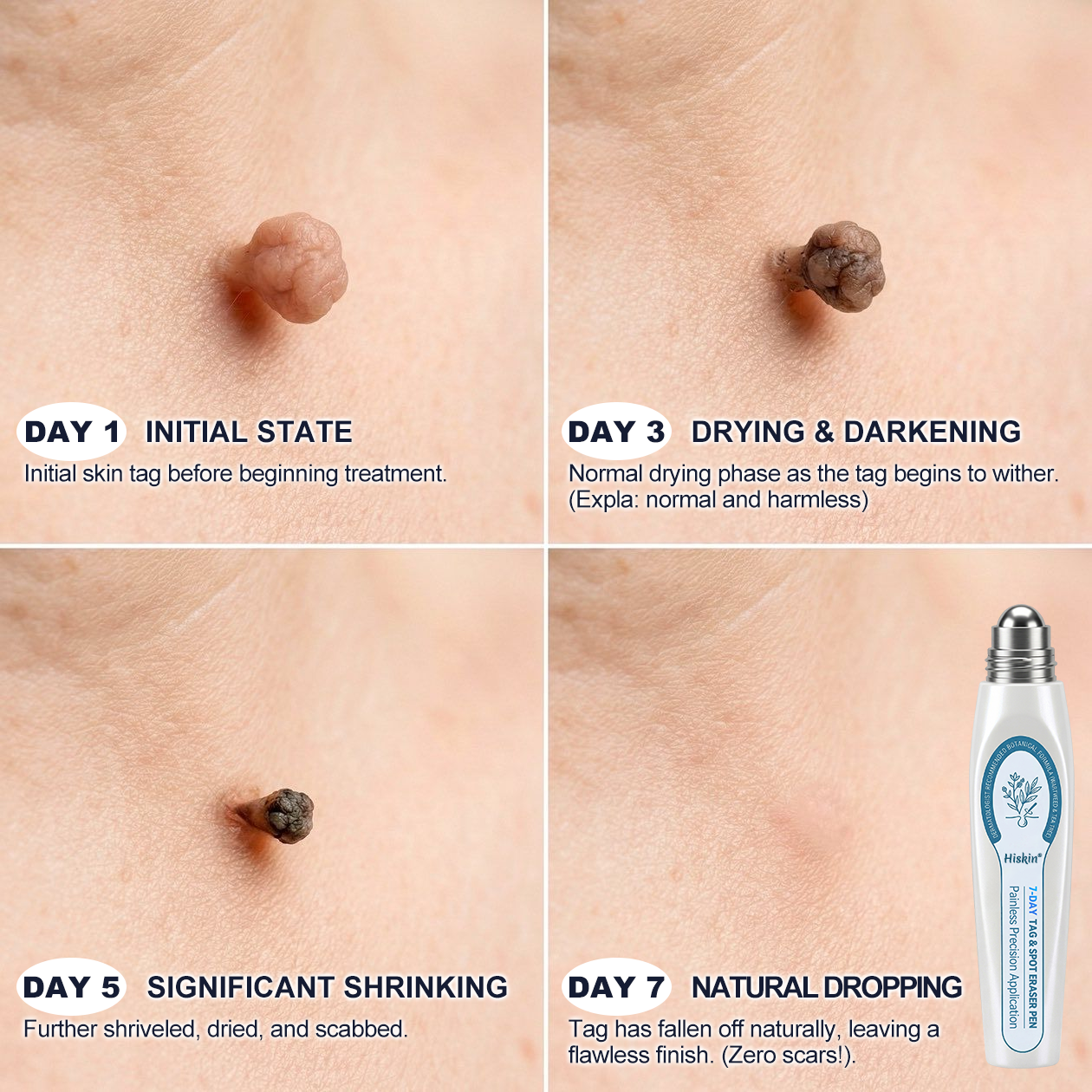 Hiskin®🩹🎉7-𝐷𝑎𝑦 𝗧𝐚𝐠 & 𝗦𝗽𝐨𝐭 𝐄𝐫𝒂𝒔𝒆𝒓(Zero Pain, Zero 𝐒𝐜𝐚𝒓𝒔 Rollerball)