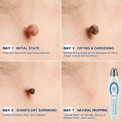 Hiskin®🩹🎉7-𝐷𝑎𝑦 𝗧𝐚𝐠 & 𝗦𝗽𝐨𝐭 𝐄𝐫𝒂𝒔𝒆𝒓(Zero Pain, Zero 𝐒𝐜𝐚𝒓𝒔 Rollerball)